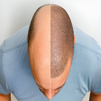 Thinning Hair in Lewisham Way? Can Scalp Micropigmentation Be the Answer?