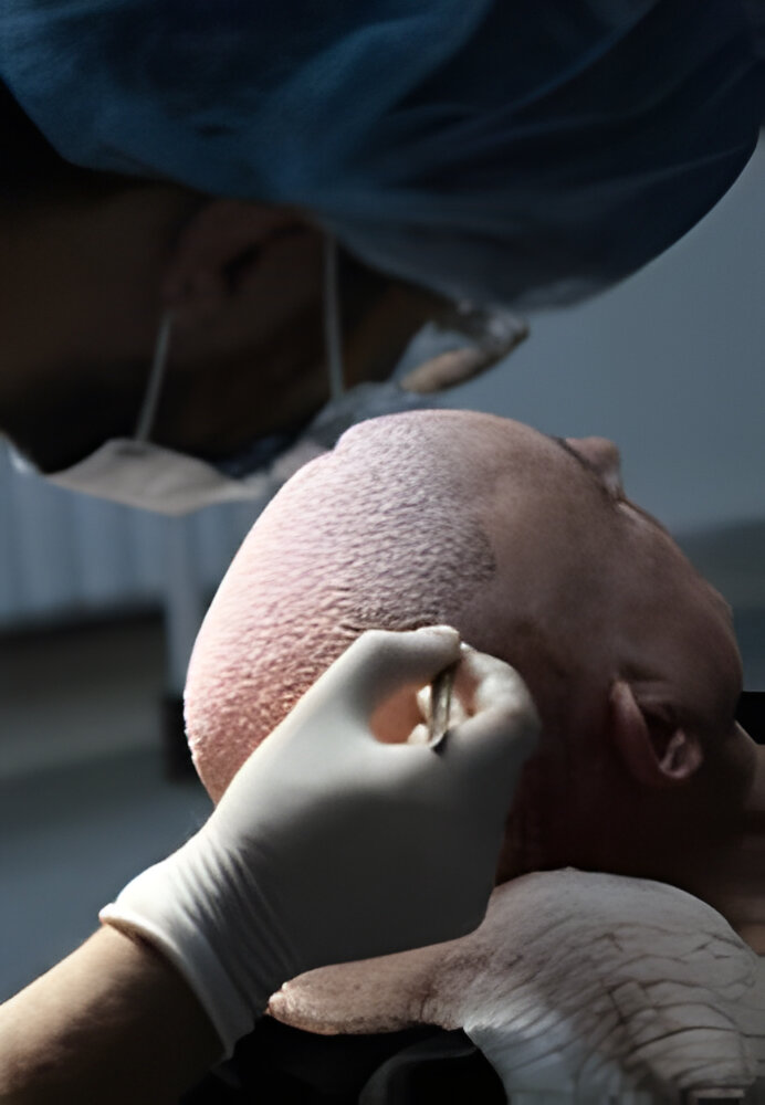 scalp micropigmentation