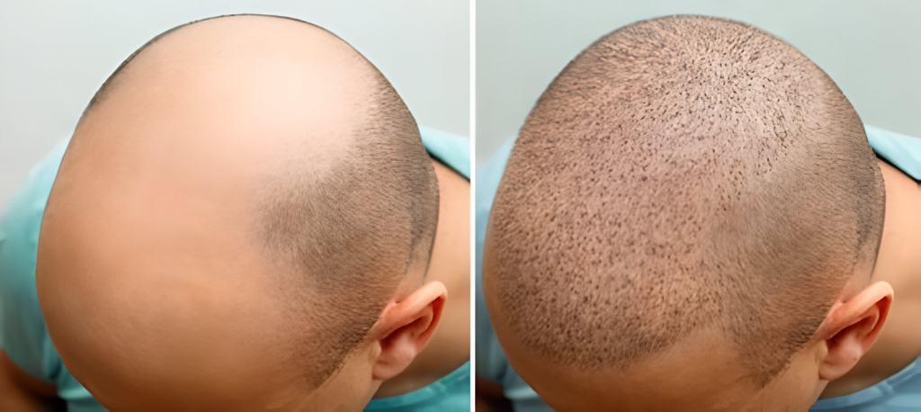 Scalp Micropigmentation